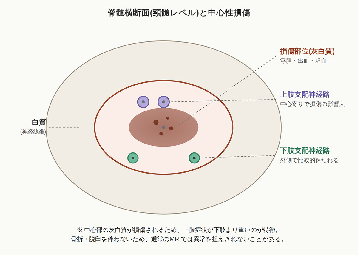 脊髄横断面(頸髄レベル)と中心性損傷の図解
